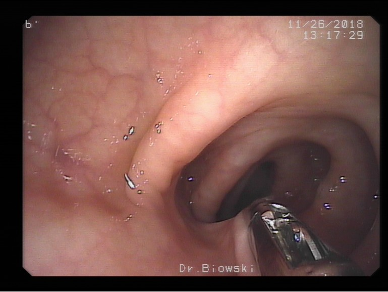 Koloskopie (Darmspiegelung): Polypektomie (Entfernung) eines Polypen mit der Zange
